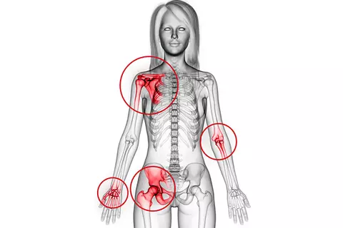 Grafik einer Arthrose