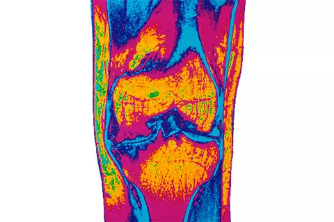 Grafik eines MRTs bei Arthrose